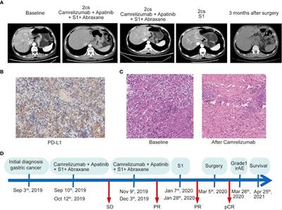 Pathologic complete response to chemoimmunotherapy of an advanced gastric cancer patient with high PD-L1 expression, dMMR, and unique gut microbiota composition: A case report